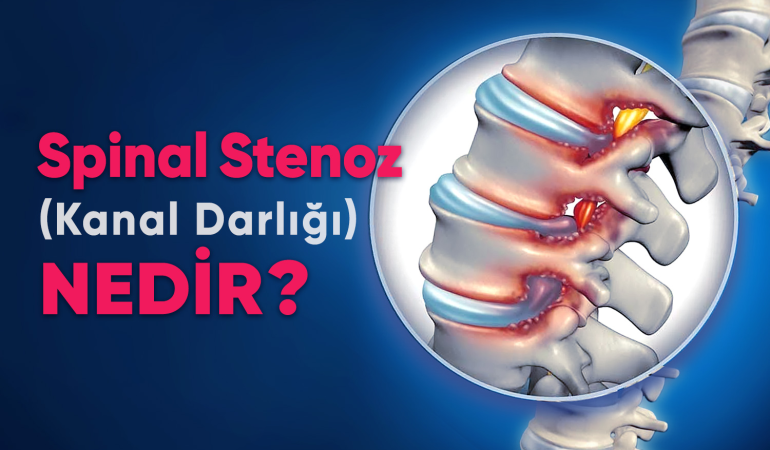 Yürürken Zorluk Çekiyorsanız Sebebi Bu Olabilir: Omurga Kanal Daralması