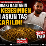 Yalova’da 76 Yaşındaki Hastanın Vücudundan 3 Bini Aşkın Taş Çıkarıldı