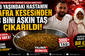 Yalova’da 76 Yaşındaki Hastanın Vücudundan 3 Bini Aşkın Taş Çıkarıldı
