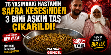 Yalova’da 76 Yaşındaki Hastanın Vücudundan 3 Bini Aşkın Taş Çıkarıldı