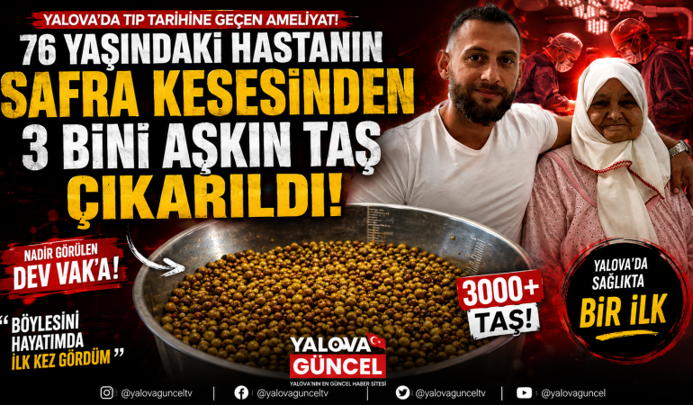 Yalova’da 76 Yaşındaki Hastanın Vücudundan 3 Bini Aşkın Taş Çıkarıldı