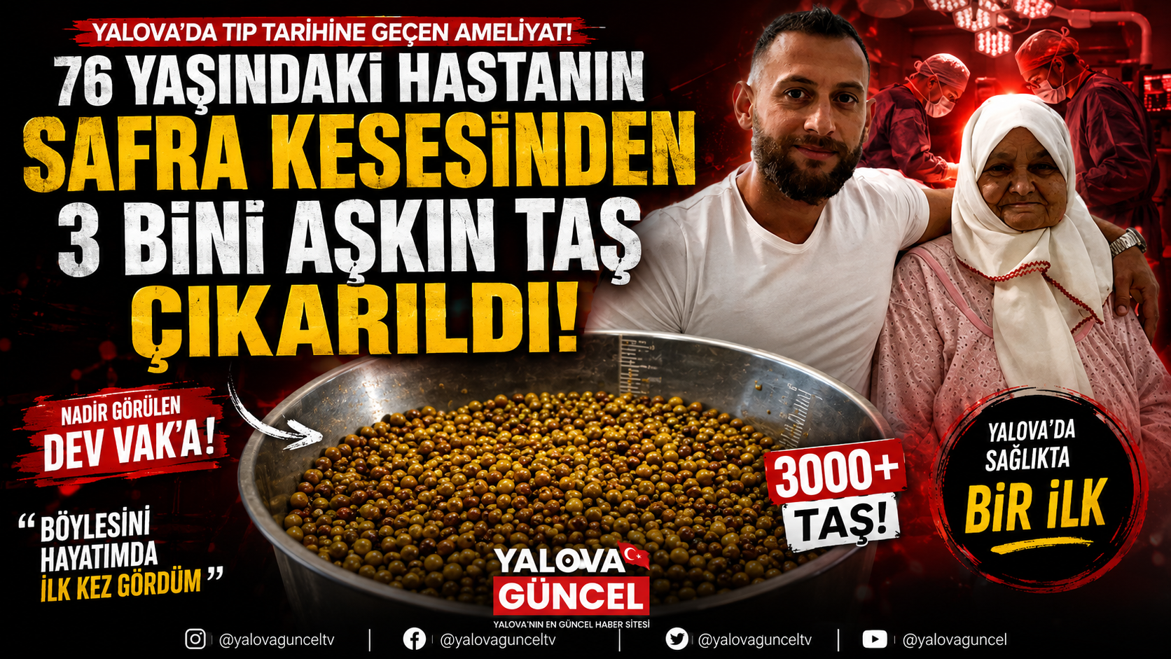 Yalova’da 76 Yaşındaki Hastanın Vücudundan 3 Bini Aşkın Taş Çıkarıldı